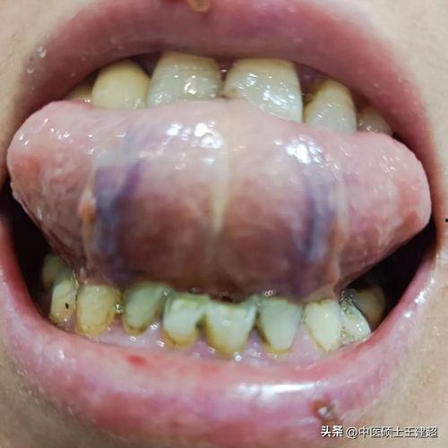 吃瓜把舌头吃破了图片,吃瓜引发的意外“事故”